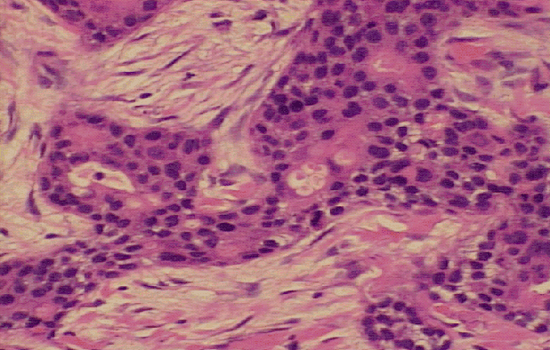 epithelioma of jadassohngfk00175.gif